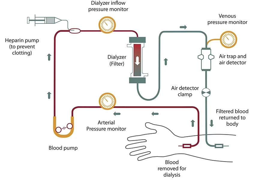 High Flux Low Flux Dialyzer High Flux Low Flux Dialyzer